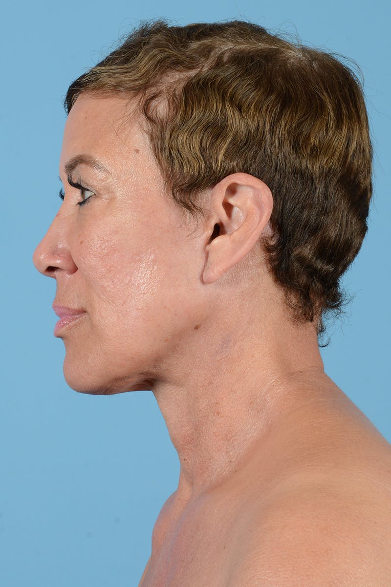Facelift Before & After Gallery - Patient 351920 - Image 12