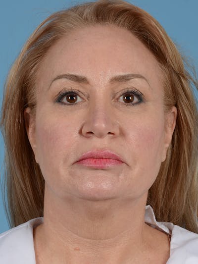 Facelift Before & After Gallery - Patient 414354 - Image 1