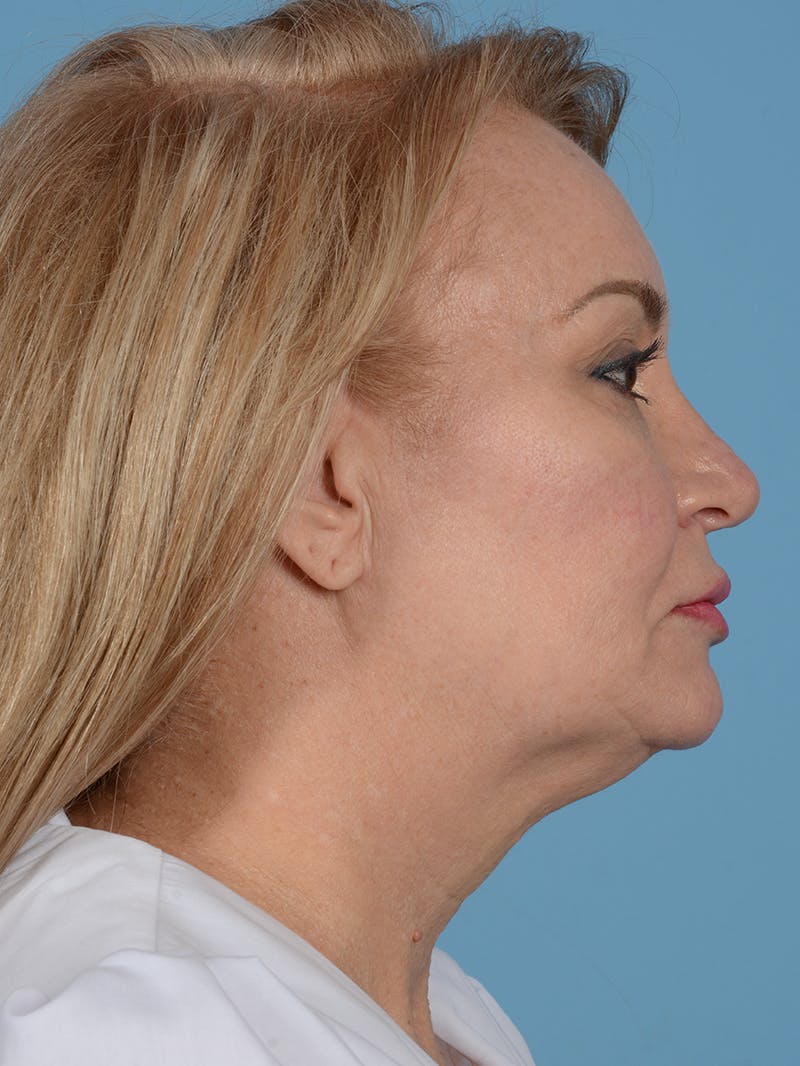 Facelift Before & After Gallery - Patient 414354 - Image 5