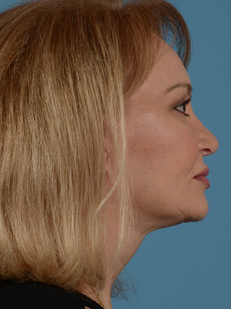Facelift Before & After Gallery - Patient 414354 - Image 6