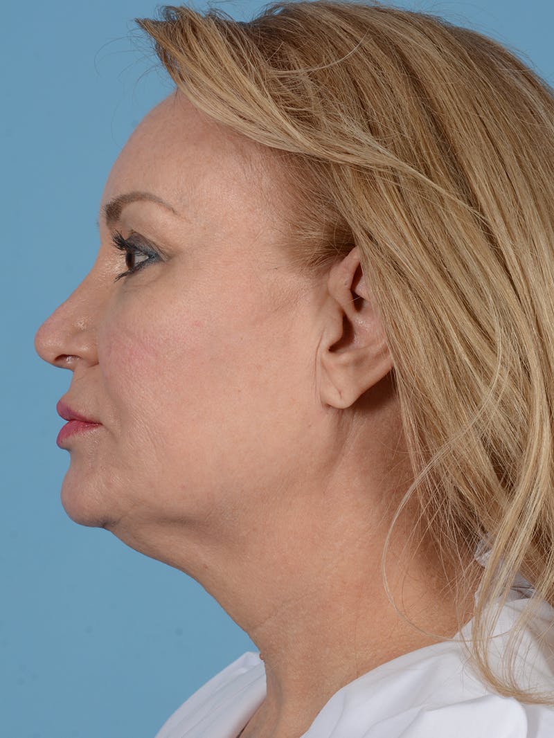Facelift Before & After Gallery - Patient 414354 - Image 7
