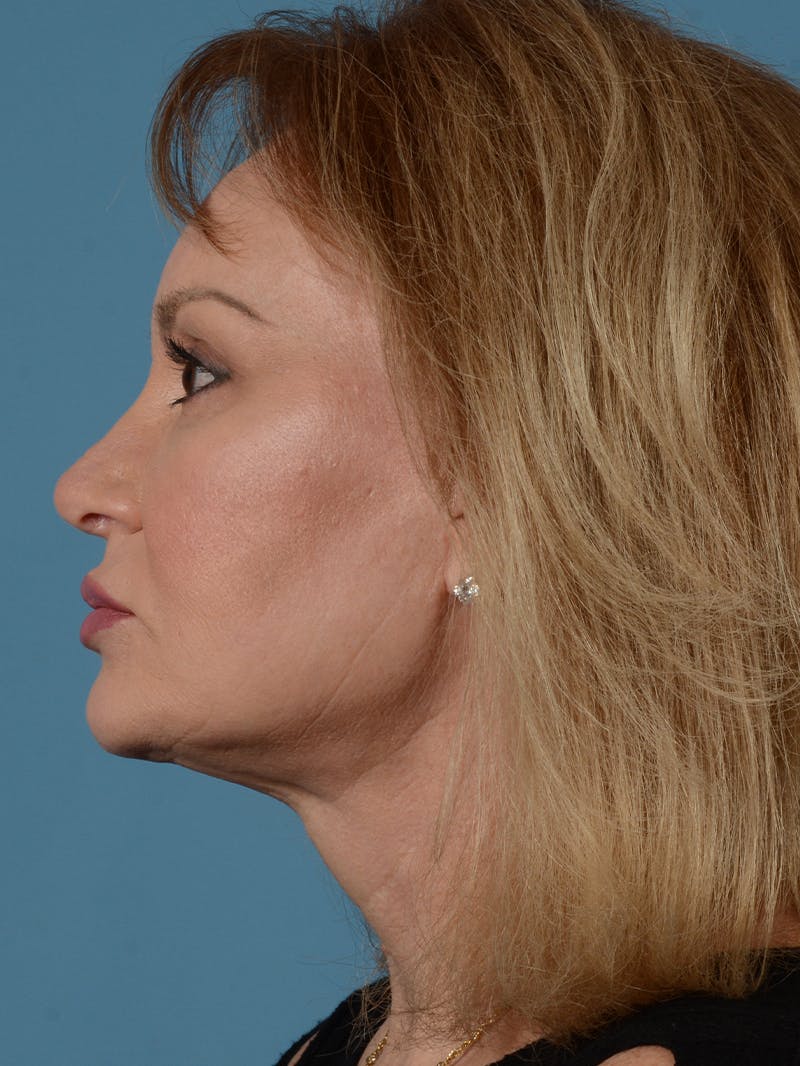 Facelift Before & After Gallery - Patient 414354 - Image 8