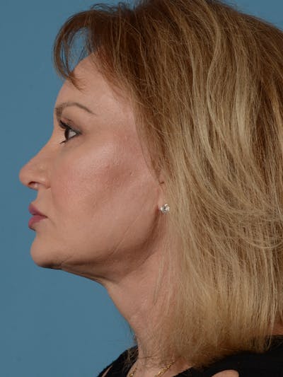 Facelift Before & After Gallery - Patient 414354 - Image 8
