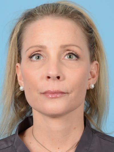 Facelift Before & After Gallery - Patient 165482 - Image 2