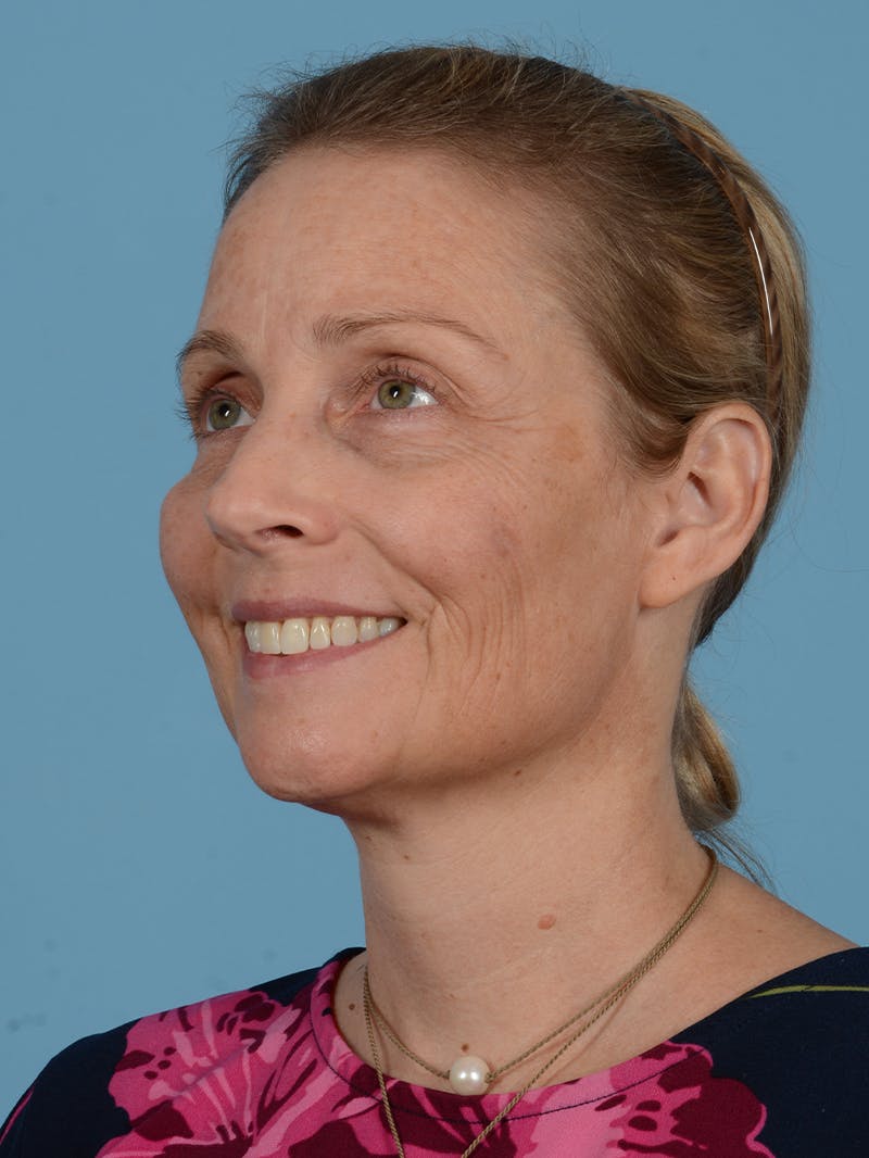 Facelift Before & After Gallery - Patient 165482 - Image 5