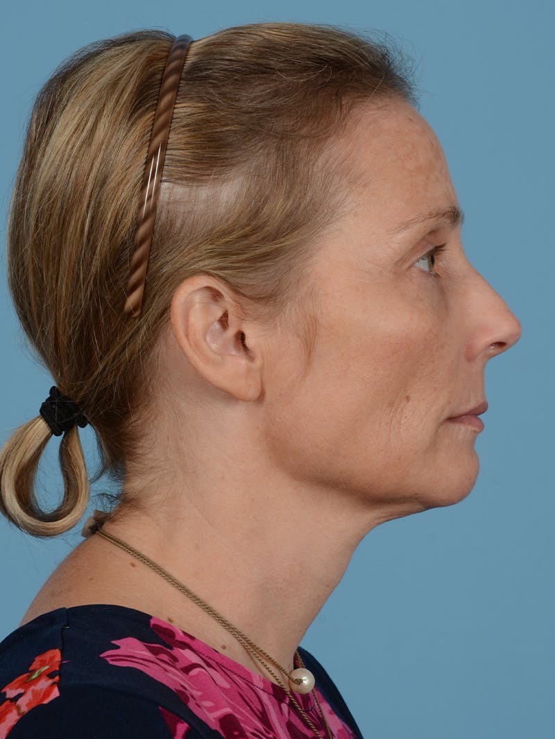 Facelift Before & After Gallery - Patient 165482 - Image 7