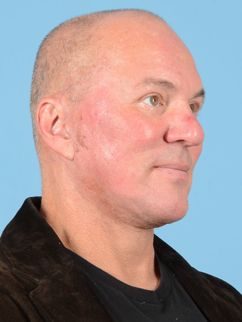 Facelift Before & After Gallery - Patient 140690 - Image 4