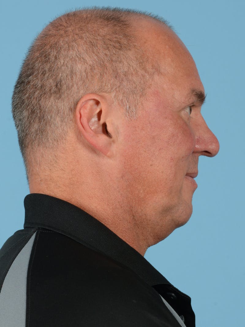Facelift Before & After Gallery - Patient 140690 - Image 5
