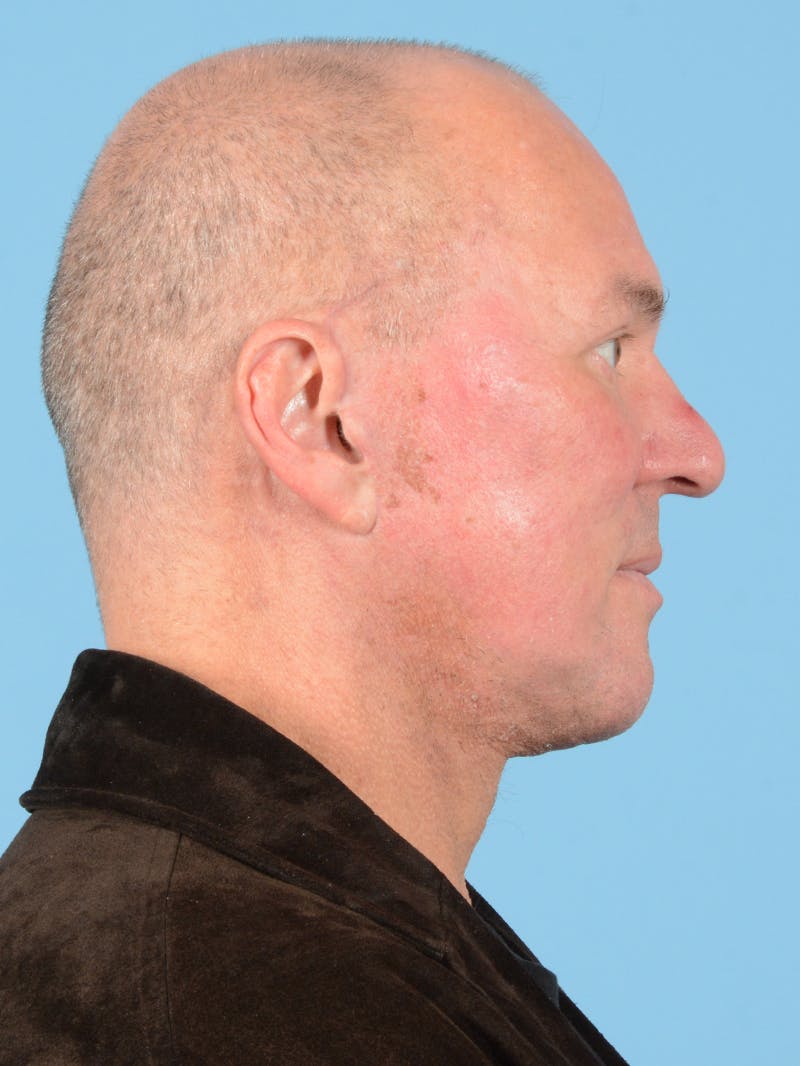 Facelift Before & After Gallery - Patient 140690 - Image 6
