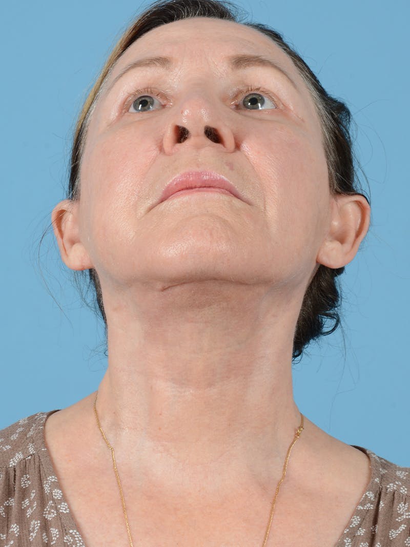 Facelift Before & After Gallery - Patient 132065 - Image 4