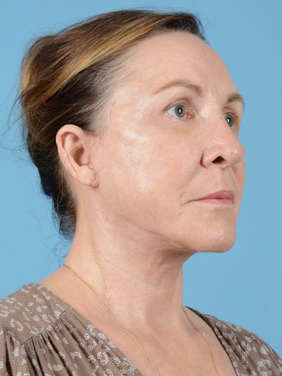 Facelift Before & After Gallery - Patient 132065 - Image 6