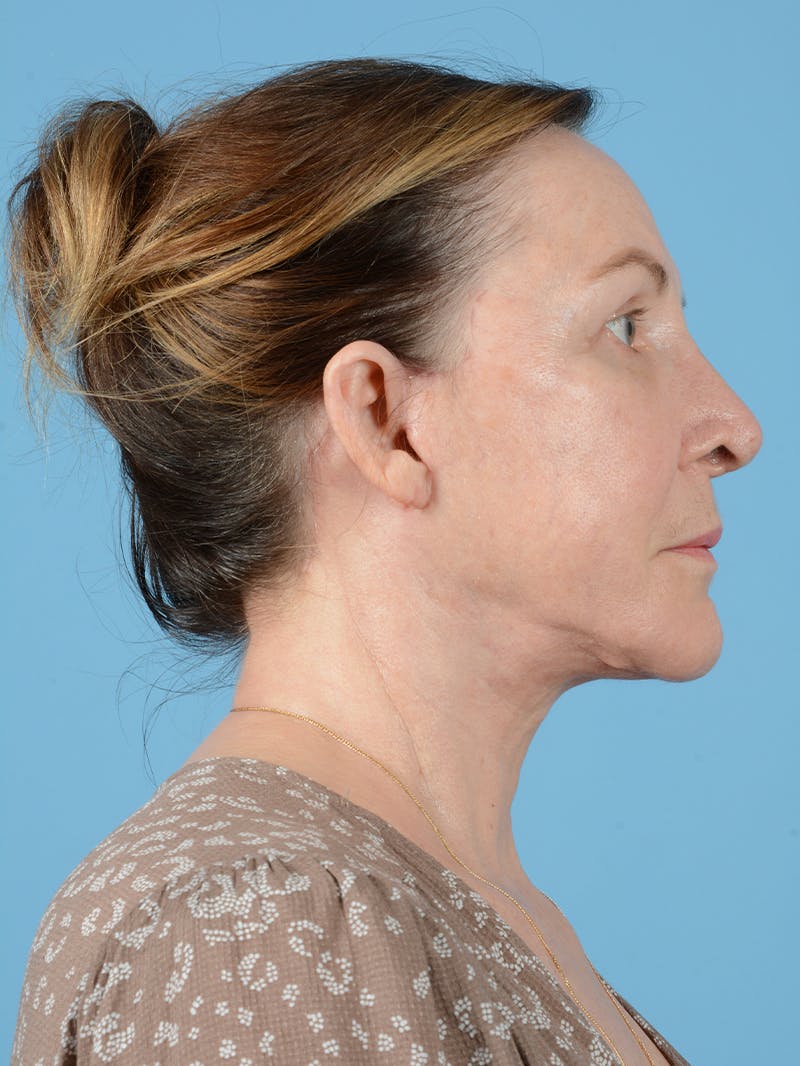 Facelift Before & After Gallery - Patient 132065 - Image 8