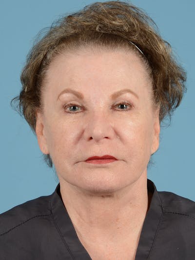 Facelift Before & After Gallery - Patient 116454 - Image 2