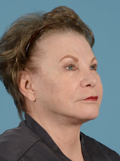 Facelift Before & After Gallery - Patient 116454 - Image 4