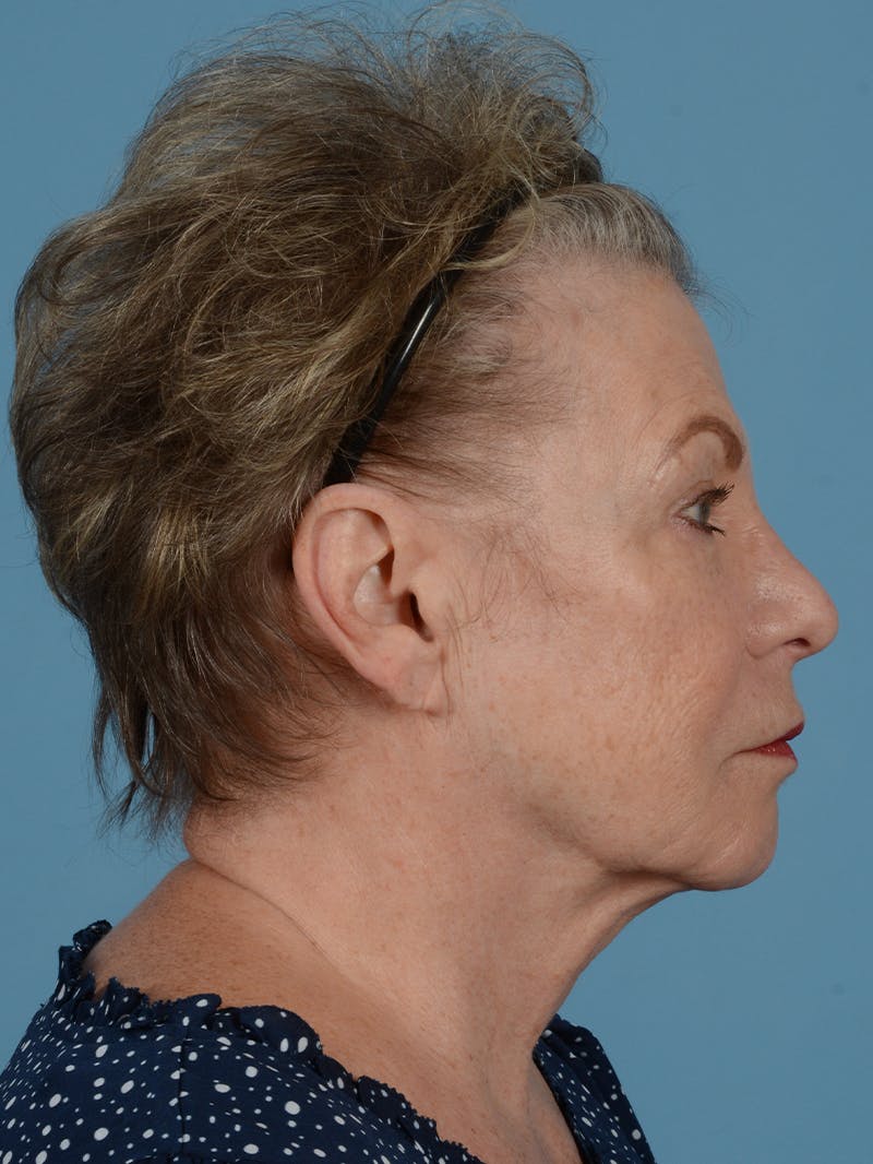 Facelift Before & After Gallery - Patient 116454 - Image 5