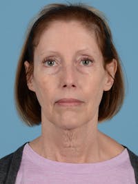 Facelift Before & After Gallery - Patient 176557 - Image 1