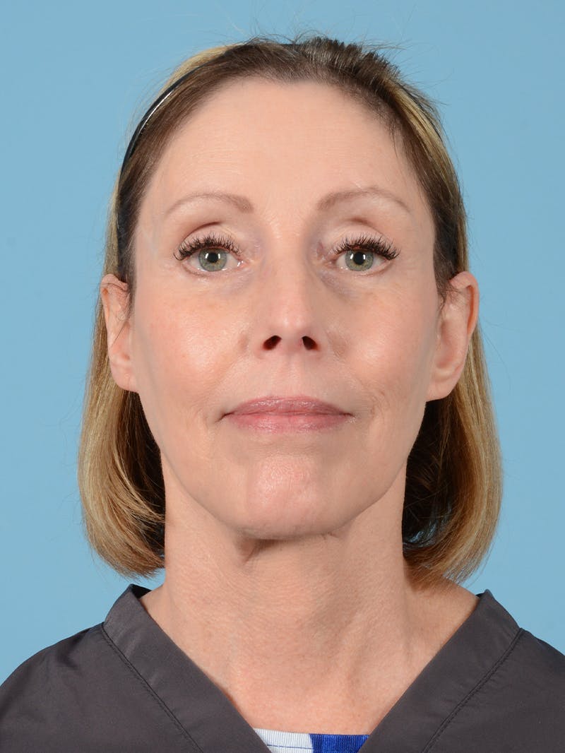 Facelift Before & After Gallery - Patient 176557 - Image 2