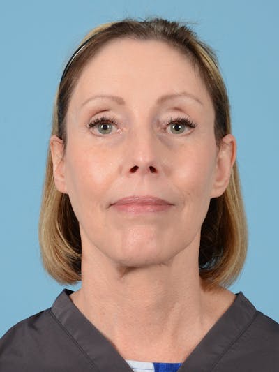 Facelift Before & After Gallery - Patient 176557 - Image 2