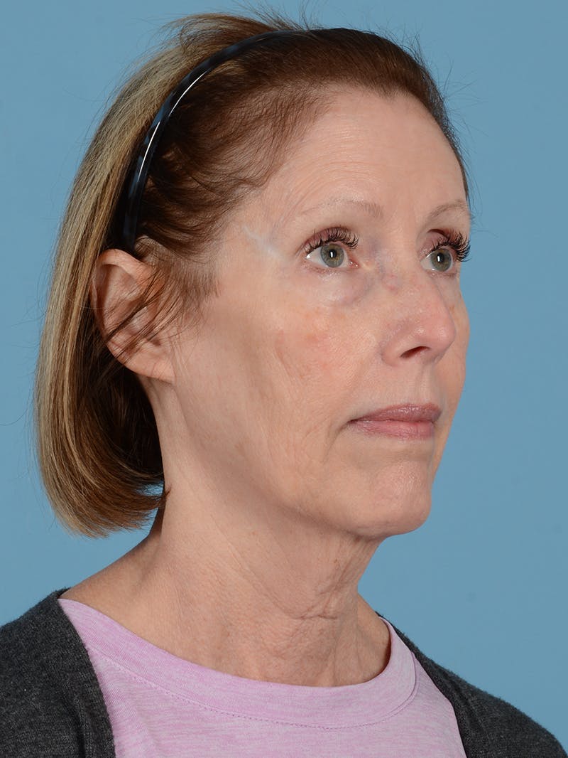 Facelift Before & After Gallery - Patient 176557 - Image 5