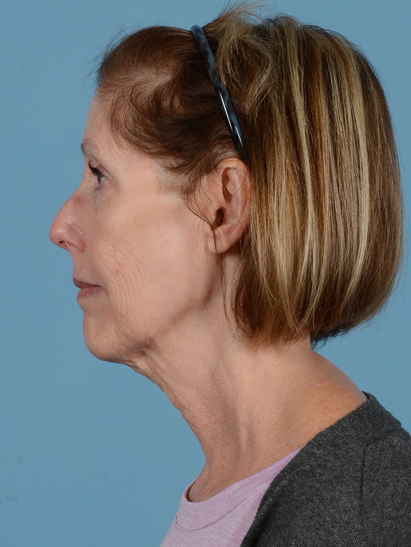 Facelift Before & After Gallery - Patient 176557 - Image 9