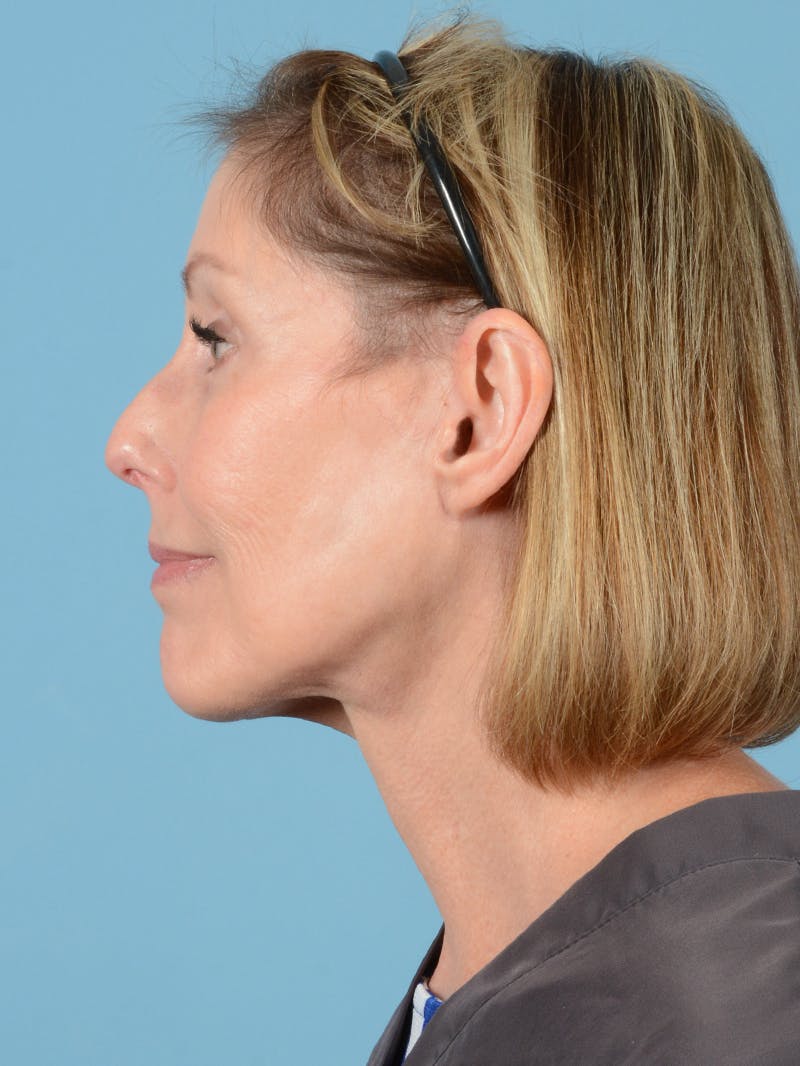 Facelift Before & After Gallery - Patient 176557 - Image 10