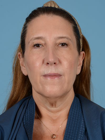 Facelift Before & After Gallery - Patient 414353 - Image 1