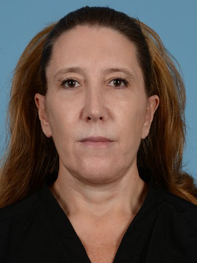 Facelift Before & After Gallery - Patient 414353 - Image 2