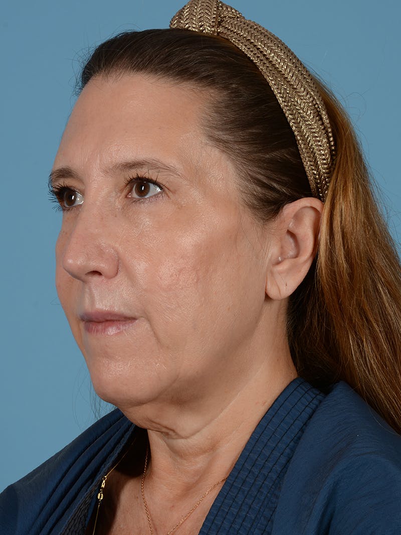 Facelift Before & After Gallery - Patient 414353 - Image 3