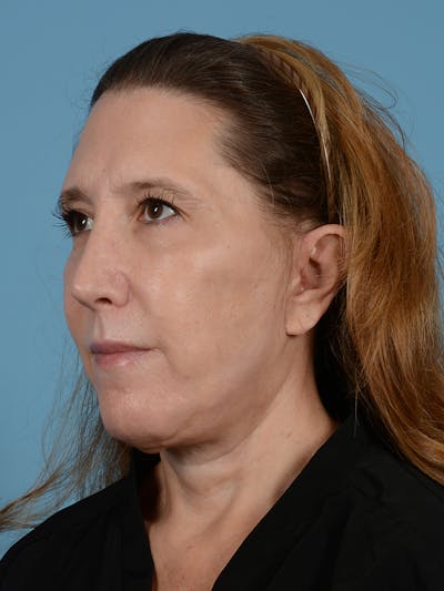 Facelift Before & After Gallery - Patient 414353 - Image 4