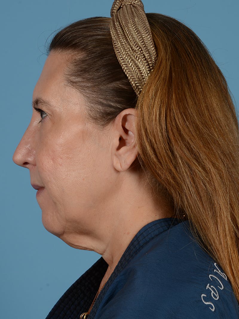 Facelift Before & After Gallery - Patient 414353 - Image 5