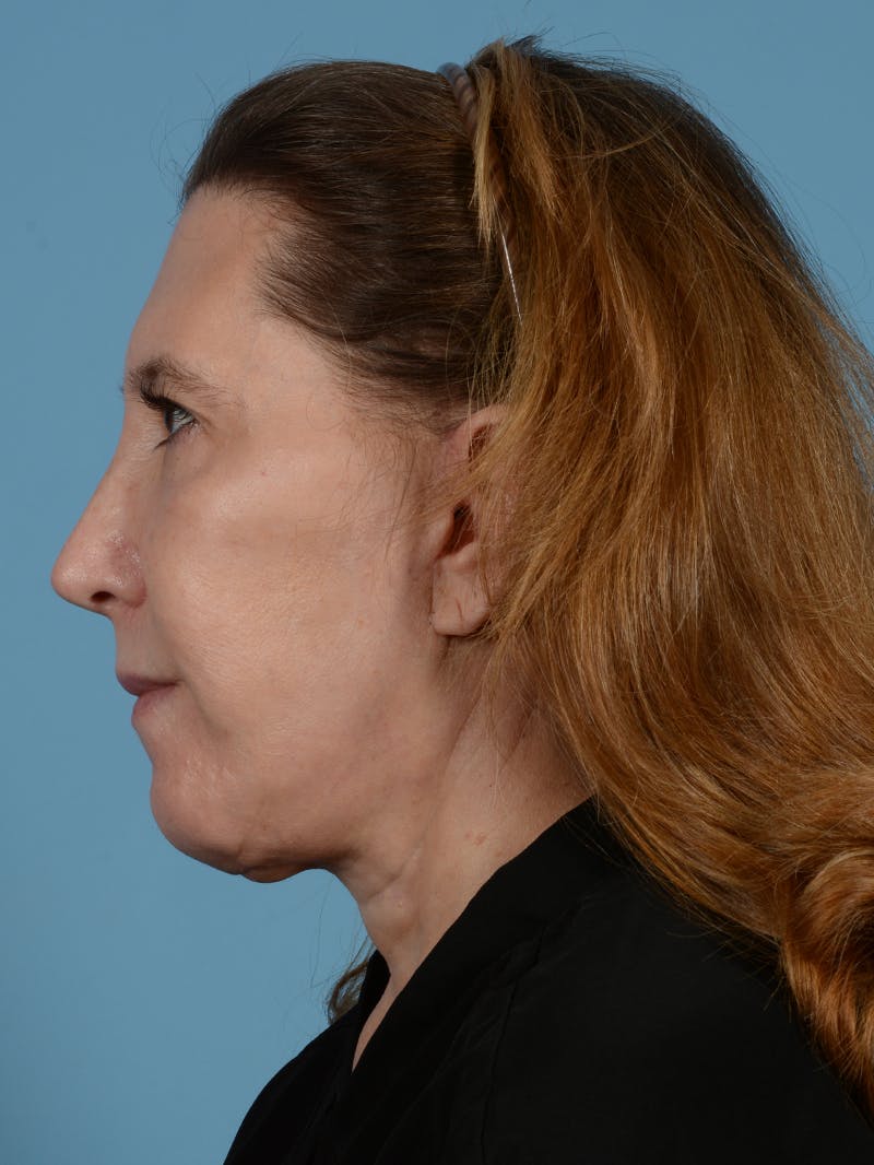 Facelift Before & After Gallery - Patient 414353 - Image 6