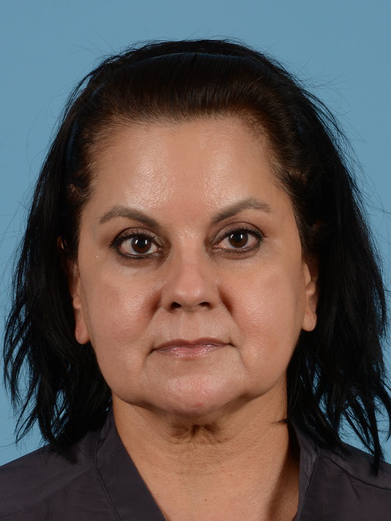 Facelift Before & After Gallery - Patient 287496 - Image 1