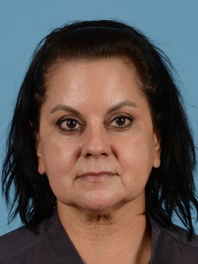 Facelift Before & After Gallery - Patient 287496 - Image 1
