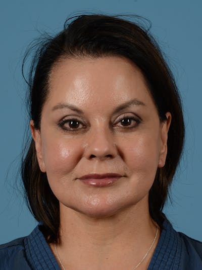 Facelift Before & After Gallery - Patient 287496 - Image 2