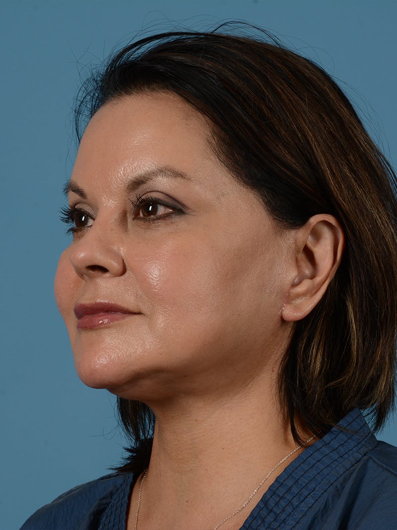 Facelift Before & After Gallery - Patient 287496 - Image 4