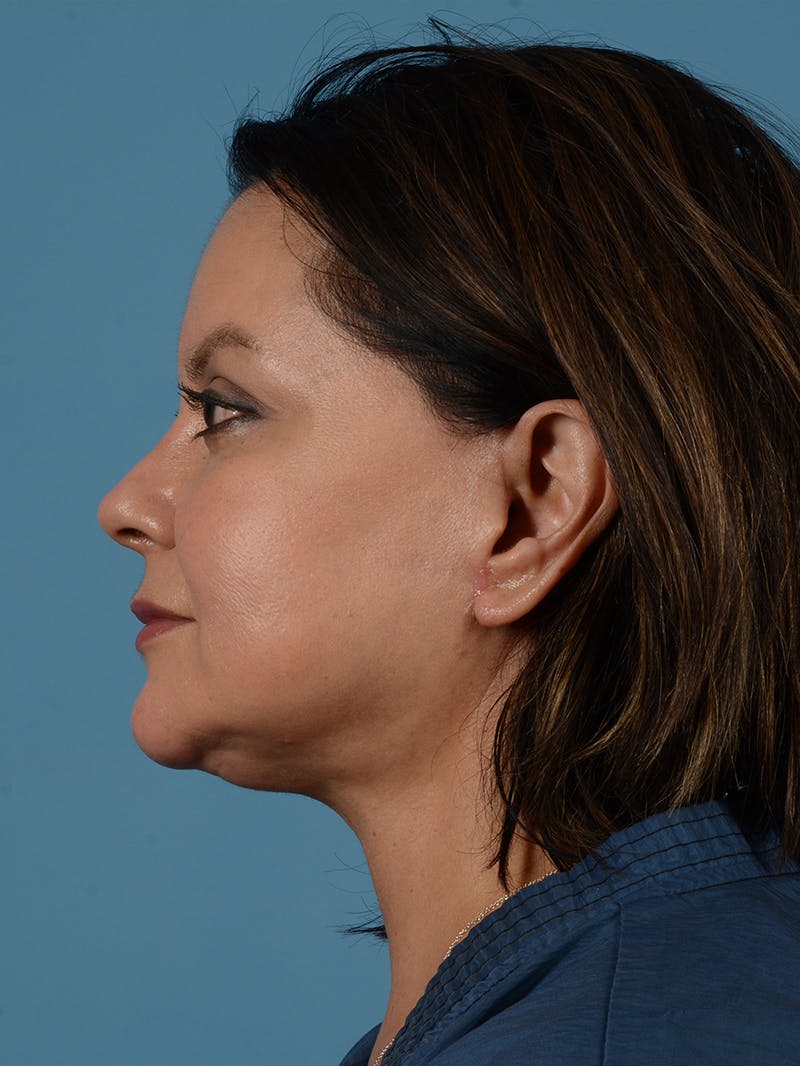 Facelift Before & After Gallery - Patient 287496 - Image 6
