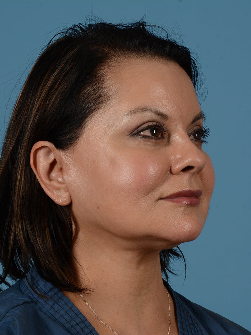 Facelift Before & After Gallery - Patient 287496 - Image 8