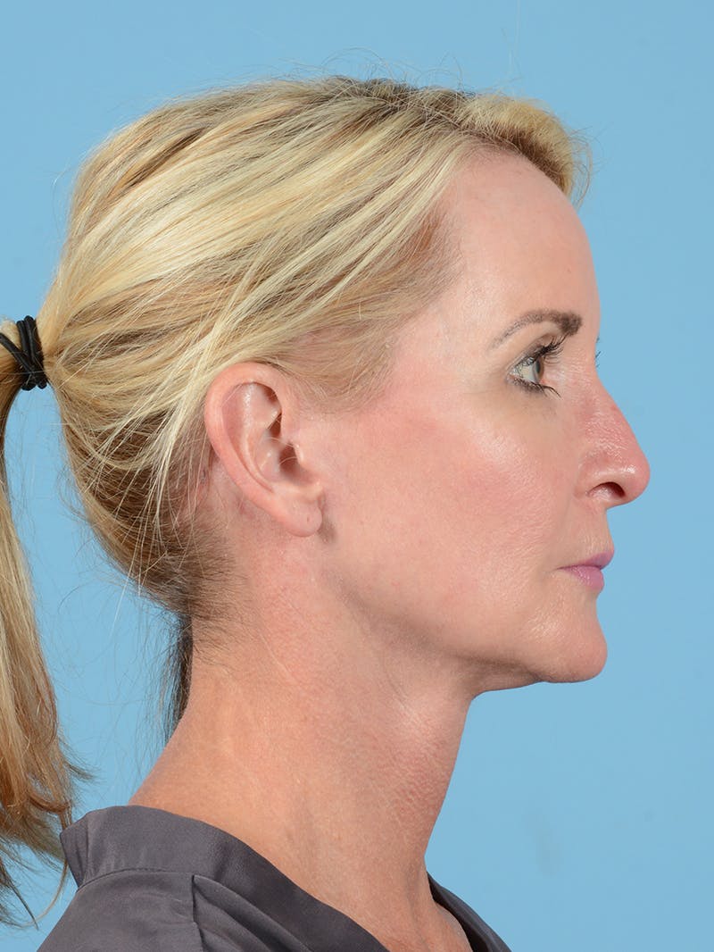 Facelift Before & After Gallery - Patient 313998 - Image 6