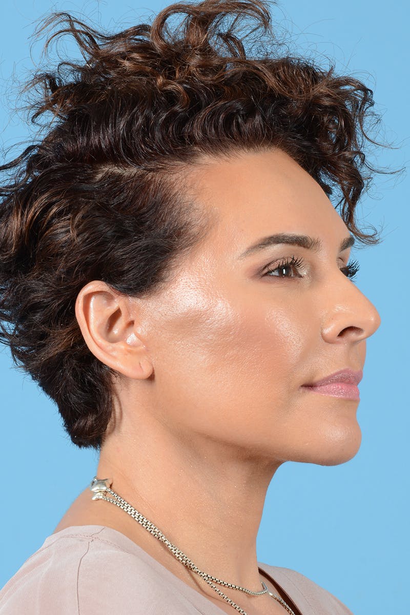 Neck Lift Before & After Gallery - Patient 381006 - Image 8