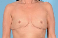 Breast Augmentation Before & After Gallery - Patient 171208 - Image 1