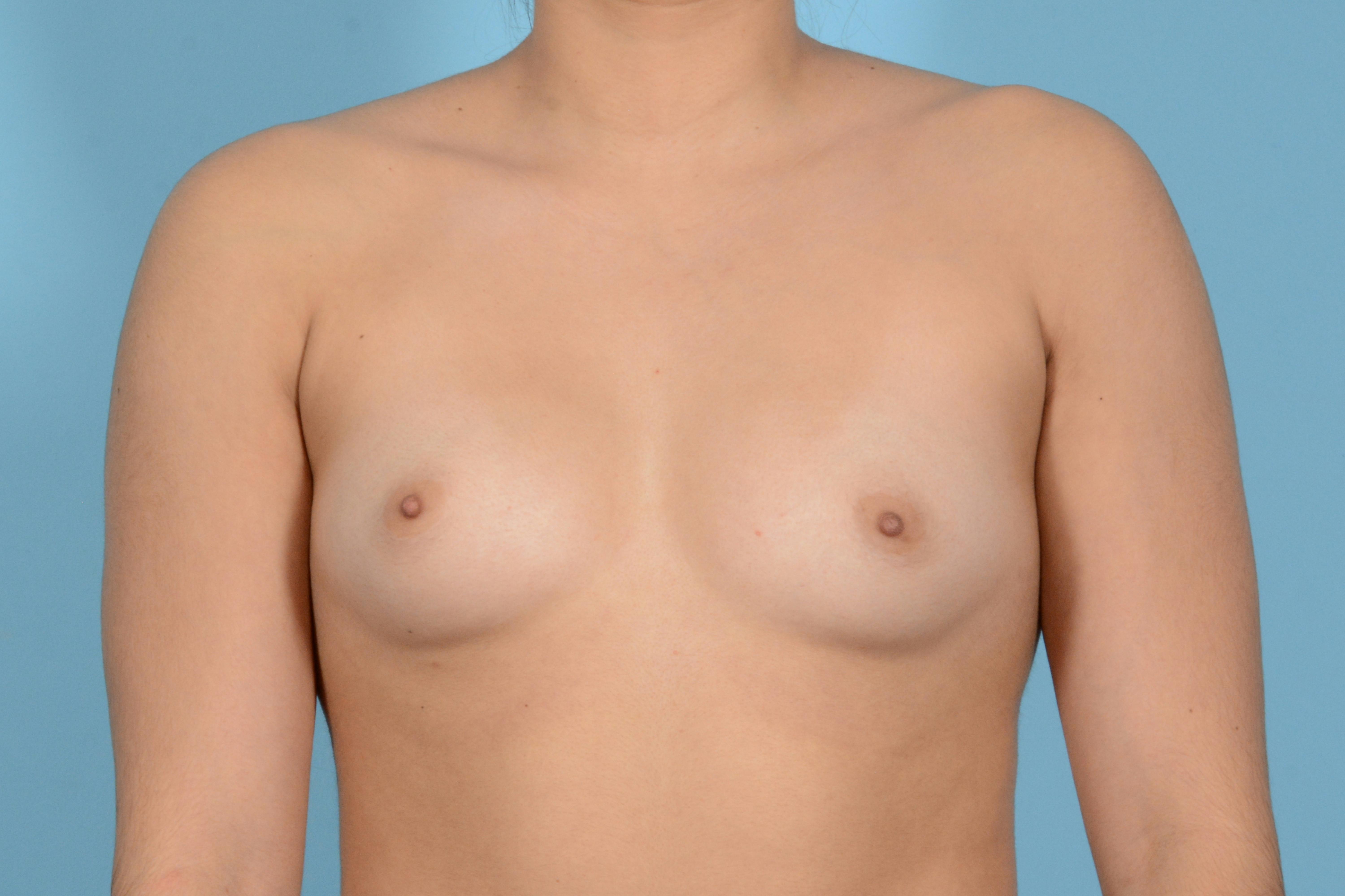 Breast Augmentation Before & After Gallery - Patient 845252 - Image 1