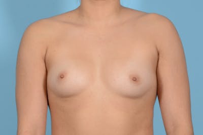 Breast Augmentation Before & After Gallery - Patient 845252 - Image 1
