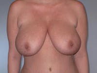 Breast Reduction Before & After Gallery - Patient 137735 - Image 1