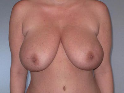 Breast Reduction Before & After Gallery - Patient 137735 - Image 1