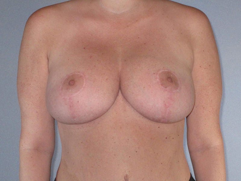 Breast Reduction Before & After Gallery - Patient 137735 - Image 2