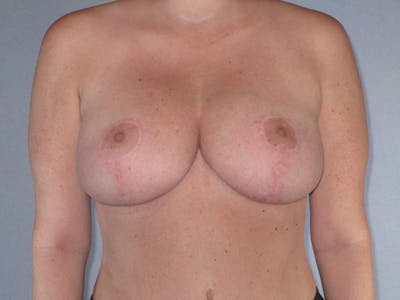 Breast Reduction Before & After Gallery - Patient 137735 - Image 2