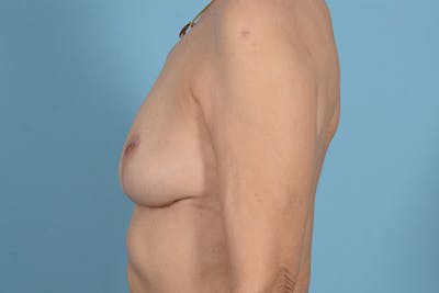 Breast Implant Removal Before & After Gallery - Patient 119942 - Image 10
