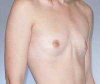 Breast Augmentation Before & After Gallery - Patient 284394 - Image 1