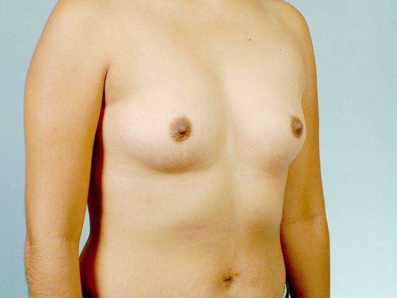Breast Augmentation Before & After Gallery - Patient 388864 - Image 3