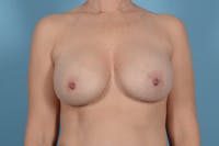 Breast Implant Exchange Before & After Gallery - Patient 238158 - Image 1